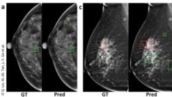 Image: A set of annotated mammogram images comparing ground truth labels with AI-based predictions; Copyright: Q. Lin, W.-M. Tan, J.-Y. Ge et al.