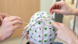 Image: This image shows the electrodes of the CI cap which is put on a patient´s head. Three hands are coating the electrodes with contact gel; Copyright: Karin Kaiser / MHH