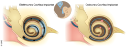 Image: Illustration of the way an optical Cochlear implant functions; Copyright: UMG